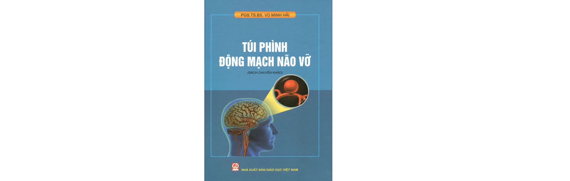 Túi phình động mạch não vỡ